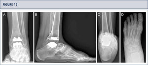 39-year old woman with rheumatoid arthritis presenting with a painful ankle 9 years after TAR (S.T.A.R ankle). A) AP-view of the ankle showing some trabecular formation over the pegs following stress shielding and cyst formation; B); lateral view of the foot showing subsidence of talar component and extensive cyst formation at tibial and talar side; C), Saltzman alignment view showing a slightly varus malalignment; D) AP-view of the foot showing a supination and adductus deformity.