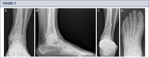 Preoperative evaluation for a painful end-stage OA in a 56-year old man 12 years after a pilon tibial fracture: Standard weight-bearing X-rays. A) AP-view of the ankle; B); lateral viewof the foot C), Saltzman alignment view; D) AP-view of the foot.