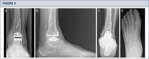 Eight-year follow-up evaluation (same patient as Fig 2): Standard weight-bearing X-rays done with the same technique under fluoroscopy allow for precise analysis. A) AP-view of the ankle; B); lateral view of the foot C), Saltzman alignment view; D) AP-view of the foot.