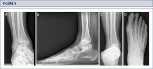 Preoperative evaluation for a painful end-stage OA in a 53-year old woman 19 years after a severe ankle sprain. Radiographic assessment evidences an advanced stage of ankle OA with bipolar subchondral cyst formation, a slight anterior extrusion of talus, anda peritalar instability with subsequent valgus tilt of talus with redagr to the calcaneus. A) AP-view of the ankle; B) lateral view of the foot; C), Saltzman alignment view; D) AP-view of the foot.