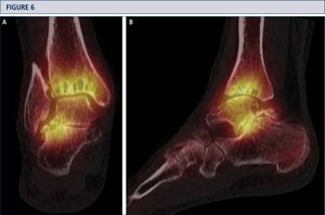 A SPECT-CT evidences an active process at ankle and subtalar joint, which helped to identify the source of pain. Based on this, a TAR in combination with a subtalar arthrodesis was done (same patient as Fig 5). A) coronal plane view; B) sagittal plane view.