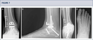 Seven years after surgery, the patient was highly satisfied with the result. Standard X-rays show a well-balanced ankle and stable implants. A) AP-view of the ankle; B) lateral view of the foot; C), Saltzman alignment view; D) AP-view of the foot.