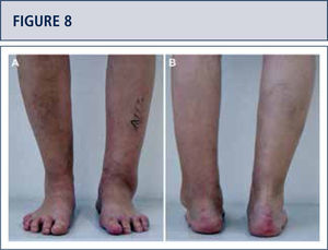 Preoperative evaluation for a painful end-stage varus OA in a 59-year old man 35 years after a malunited pilon tibial fracture: The clinical evaluation shows a marked varus malalignment of distal tibia; whereas, the heelis only slightly in varus.