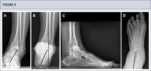 Preoperative evaluation radiographic evaluation (same patient as Fig 8). Standard weight-bearing X-rays. A) AP-view of the ankle showing a varus tilt of >30°; B) Saltzman alignment view showing a significant varus malalignment of the heel; C), lateral view of the foot showing a horizontalization of talus; D) AP-view of the foot showing a exorotation of talus with highly decreased talo-calcaneal angle.