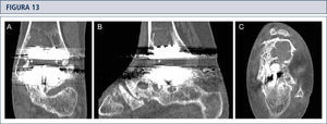La tomografía computarizada confirma la formación de quistes (mismo paciente que Fig. 12). A) plano coronal; B) plano sagital, y C) plano horizontal.