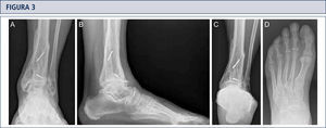 Evaluación preoperatoria en artrosis avanzada, dolorosa, en un hombre de 56 años de edad, 12 años después de una fractura de pilón tibial: Radiografías bajo carga A) vista ántero-posterior; B); vista lateral del pie C), vista de alineación de Saltzman; D) vista ántero-posterior del pie.