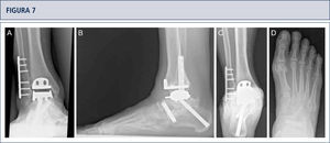 Siete años después de la cirugía, el paciente está muy satisfecho con el resultado. Radiografías muestran un tobillo bien equilibrado y los implantes estables. A) vista anteroposterior del tobillo; B) vista lateral del pie; C), vista de alineación de Saltzman; D) vista antero-posterior del pie.