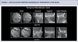 Ejemplo de imagen de tomografía Cone Beam de ATM bilateral normal, en boca cerrada y con apertura máxima no forzada.