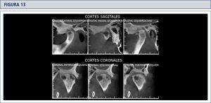 Cortes coronales y sagitales de ATM del lado izquierdo, en los cuales se observa un quiste subcondral en el polo medial del cóndilo mandibular.