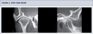 Cortes coronal y sagital de ATM, en los cuales se observa engrosamiento de las corticales óseas articulares craneales.