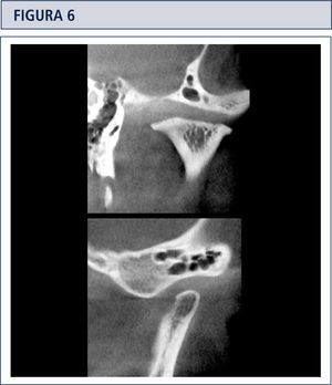 Cortes coronal y sagital de ATM, en los cuales se observa aplanamiento acentuado de las superficies óseas articulares craneal y del cóndilo mandibular, con la formación de osteofitos lateral y medial en el cóndilo mandibular.