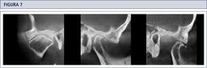 Cortes coronal y sagital de ATM en boca cerrada y sagital en apertura máxima no forzada, en los cuales se observa la presencia de un osteofito anterior fracturado, el cual se desplaza junto con el cóndilo mandibular en movimiento de apertura máxima.