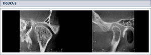Cortes coronal y sagital de ATM, en los cuales se observa erosión de la cortical ósea del cóndilo mandibular, sin compromiso del tejido óseo esponjoso subyacente.