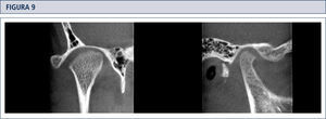 Cortes coronal y sagital de ATM, en los cuales se observa erosión de la cortical ósea del cóndilo mandibular, con compromiso del tejido óseo esponjoso subyacente.