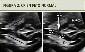 Complejo posterior en un feto normal de 25 semanas de gestación. CV, Cavum Vergae; Cc, Cuerpo calloso; SC, Surco Calloso; Pc, Plexo coroideo; FPO, Fisura Parieto-Occipital