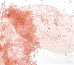 Gardnerella vaginalis Abundantes cocobacilos en cultivo de flujo.