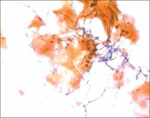 Candida SP Presencia de hifas en examen de flujo vaginal.