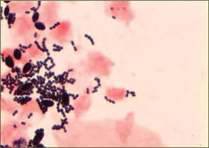 Streptococcus Grupo B Streptococcus Grupo B obtenido de flujo vaginal: En la tinción gram obsérvese el agrupamiento en cadena