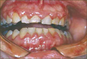 Gingivitis del embarazo generalizada