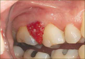 Granuloma piógeno a nivel papilar entre primer y segundo molar superior