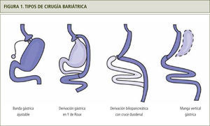 Adaptada de Caiazzo R, Arnalsteen L, Pattou F. Tipos de cirugía bariátrica A) Banda Gástrica B) Manga Gástrica C) Bypass Gástrico.