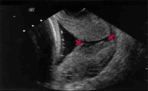 Medición de la longitud del cérvix uterino