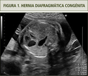 Hernia diafragmática izquierda en un embarazo de 26 semanas. Se puede observar el corazón en dextroposición y el estómago visible en el corte de cuatro cámaras. Además se destaca la medición del pulmón residual para el cálculo del LHR.