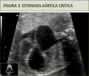 En la imagen se puede indentificar el ventrículo izquierdo y aurícula izquierda dilatados. Además se observa la estenosis en la salida de la aorta.