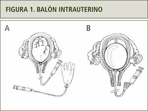 La imagen (A) muestra cómo se puede confeccionar un balón intrauterino utilizando una sonda vesical y un guante estéril en caso de no contar con Balón de Bakri (B). Extraída de FIGO Safe Motherhood and Newborn Health (SMNH) Committee: Prevention and treatment of postpartum hemorrhage in low-resource settings. International Journal of Gynecology and Obstetrics; Vol: 11, 2012. 108–118.