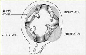 Clasificación tipos de Acretismo Placentario Extraída de FIGO Safe Motherhood and Newborn Health (SMNH) Committee: Prevention and treatment of postpartum hemorrhage in low-resource settings. International Journal of Gynecology and Obstetrics; Vol: 11, 2012. 108–118.