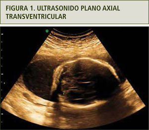 Se observa deformidad anterior en relación a sutura coronal.