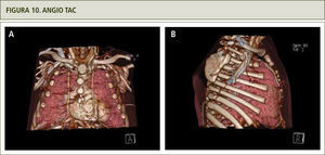 Arteria mamaria externa aumentada de tamaño. a) Visión frontal. b) Visión lateral.