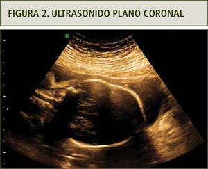 Se observa deformidad en relación a suturas coronales.