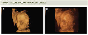 a) Modo de superficie, se observa cara con depresión de la parte media y ptosis palpebral, ausencia de suturas coronales. b) Modo de rayos x, ausencia de suturas coronales.