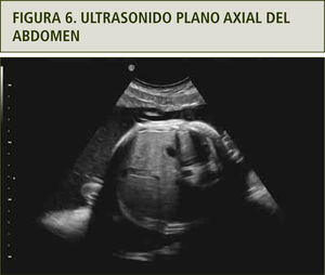Se observa polihidroamnios y estómago de pequeño tamaño.