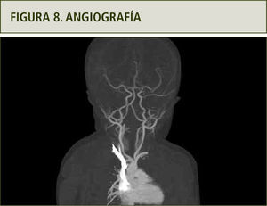 Vasos del cuello y aorta se observan tortuosos.