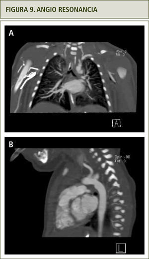 a) Plano coronal de tórax, vasos del cuello y aorta se observan tortuosos. b) Plano sagital de tórax, se observa aorta tortuosa.