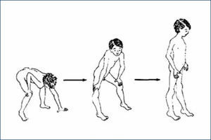 . SIGNO DE GOWERS.