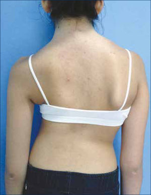 ASPECTO DEL TORSO DE UNA PACIENTE DE 11 AÑOS. La paciente es portadora de una escoliosis estructural. Desnivel de hombros, prominencia escapular y asimetría del triángulo del talle. Autorizado por paciente para publicación de foto.