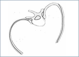 ESQUEMA DE LA ROTACIÓN VERTEBRAL. Efecto de elevación de las costillas en la convexidad que determina la asimetría en el Test de Adams.