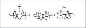 ESQUEMA DE LA ROTACIÓN VERTEBRAL. Note cómo uno de los pedículos se aleja mientras el opuesto se acerca a la línea media.