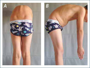 TEST DE ADAMS. Flexión anterior de tronco para la visión tangencial de asimetría causada por elevación costal y/o lumbar. Autorizado por paciente para publicación de fotos.