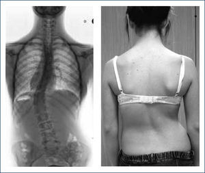 RADIOGRAFÍA ANTEROPOSTERIOR DE UNA PACIENTE DE 13 AÑOS. La paciente es portadora de escoliosis idiopática. Se evidencia la rotación máxima de la vértebra apical, con una asimetría de los pedículos. En la imagen adjunta, el efecto clínico de la deformidad de la columna vertebral. Autorizado por paciente para publicación de fotos.