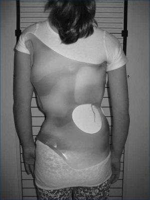 CORSET TÓRACO-LUMBAR. Manejo conservador de escoliosis. Autorizado por paciente para publicación de foto.