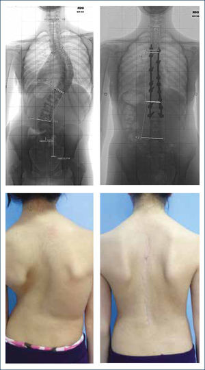 RADIOGRAFÍAS PRE Y POST OPERATORIAS. Corrección mediante fijación posterior de escoliosis en una paciente de 12 años. Autorizado por paciente para publicación de fotos.