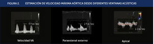 ESTIMACIÓN DE VELOCIDAD MÁXIMA AÓRTICA DESDE DIFERENTES VENTANAS ACÚSTICAS.