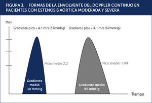 FORMAS DE LA ENVOLVENTE DEL DOPPLER CONTINUO EN PACIENTES CON ESTENOSIS AÓRTICA MODERADA Y SEVERA Rajani R et al. Heart 2012; 98, 14-22.