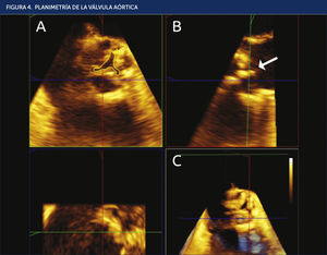 PLANIMETRÍA DE LA VÁLVULA AÓRTICA Planimetría del orifi de apertura valvular aórtico mediante el sistema de reconstrucción multiplanar (MPR). Tras seleccionar la imagen de máxima apertura valvular en la imagen 3D (C), se obtienen los planos longitudinal (B) y transversal (A) de la válvula. El plano de corte transversal (en verde) se ajusta para que pase por el borde de las cúspides (fl modifi su inclinación en caso necesario para obtener la imagen más parecida a la tridimensional. Posteriormente, se amplía la imagen para realizar la planimetría de forma manual.
