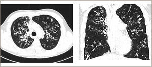 TAC DE TÓRAX PACIENTE ADULTO CON FIBROSIS QUÍSTICA CON ENFERMEDAD PULMONAR AVANZADA Y BRONQUIECTASIAS SEVERAS BILATERALES. Referencia 1. Cystic Fibrosis Foundation Patiente registry 2012 annual data report.