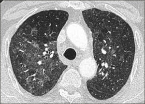 PATRÓN VIDRIO ESMERILADO: NEUMONITIS POR HIPERSENSIBILIDAD.